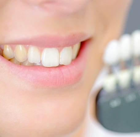 Stained Teeth Treatment