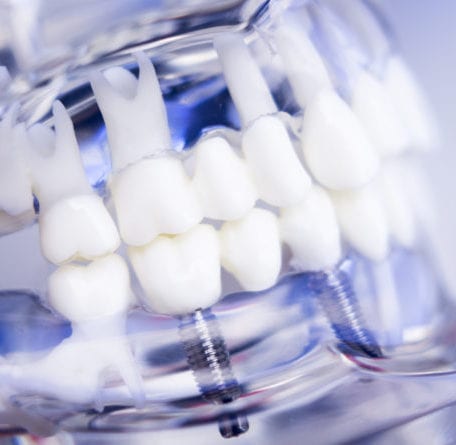 Dental Implants Pakenham