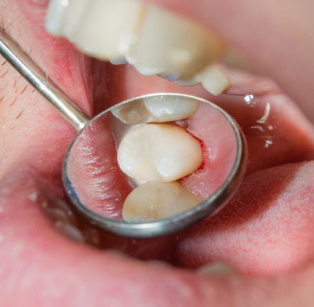 composite-filling-treatment