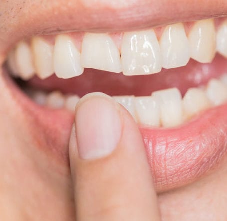 Broken Teeth Treatment