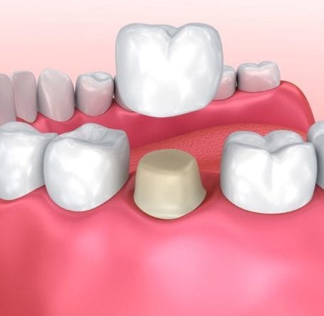 Dental Crowns Pakenham