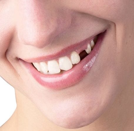 Missing Teeth Treatment Pakenham