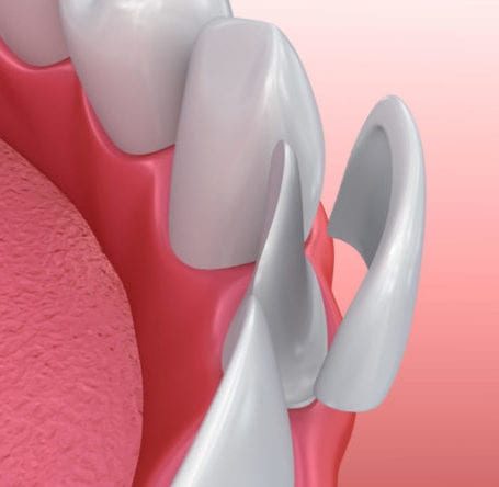 Dental Veneers Pakenham
