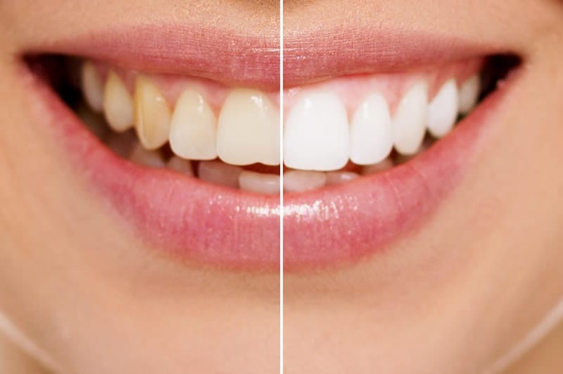 Teeth Whitening Pakenham
