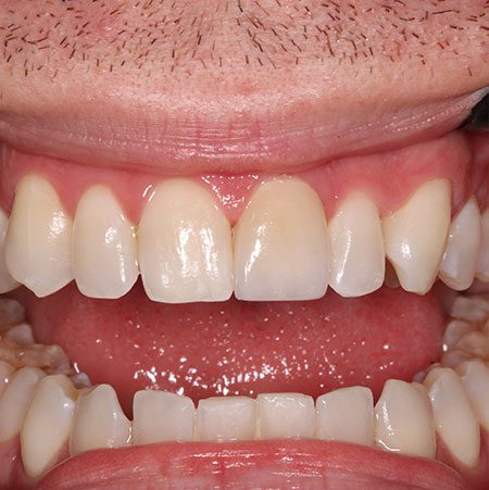 After Treatment