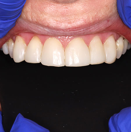After Treatment 