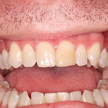 Before Treatment