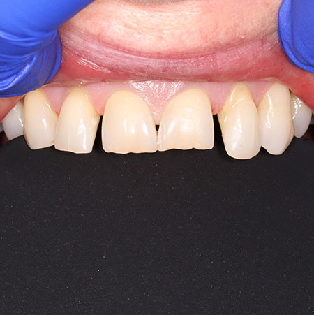 Before Treatment