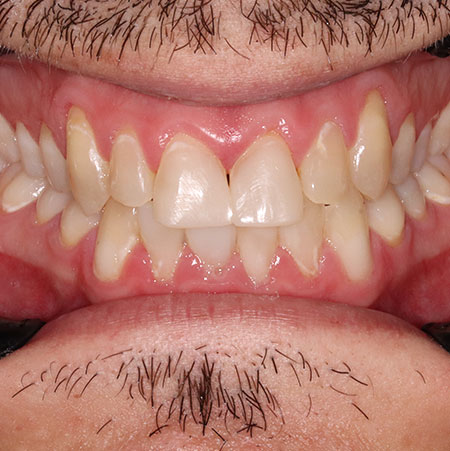 After Treatment