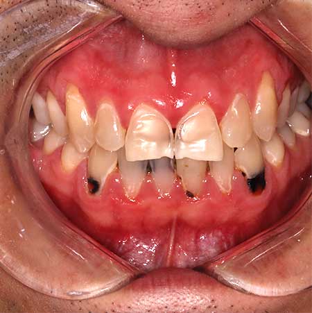 Before Treatment
