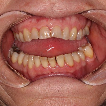 Before Treatment