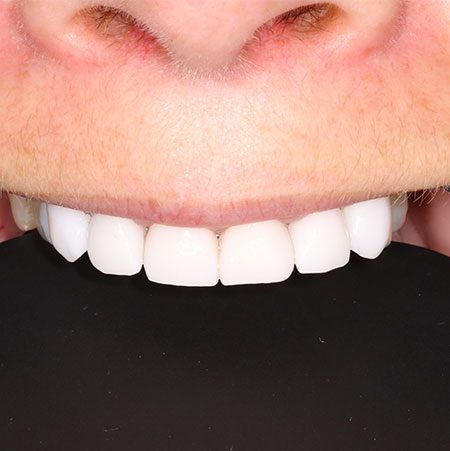 After Crowns Treatment