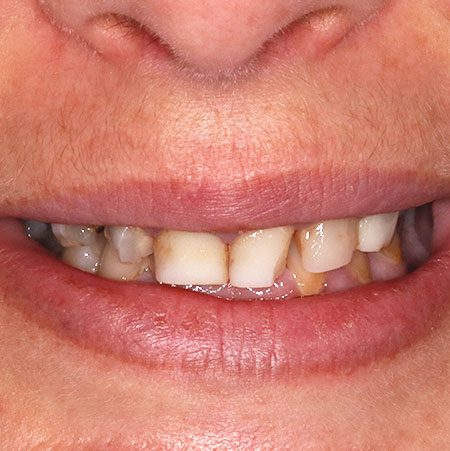 Before Crowns Treatment