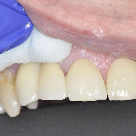 After Impant Treatment