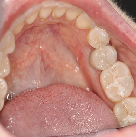 After Impants Treatment