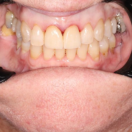 After Treatment