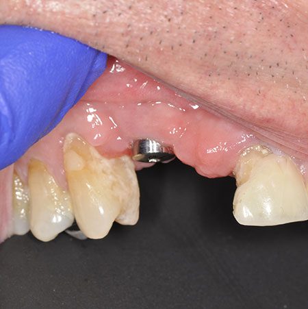Before Impant Treatment