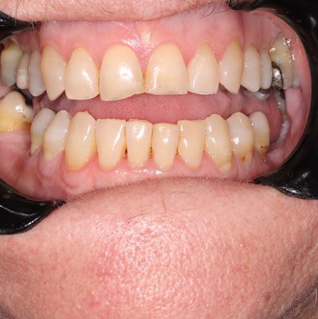 Before Treatment