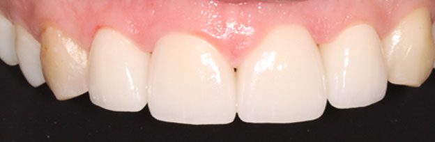 crown case after