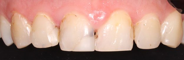 crowns case 1 before