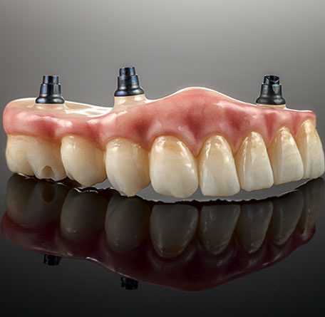 Full-arch-implants-image